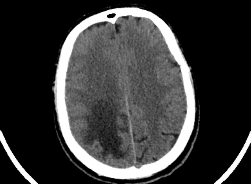 File:Brain abscess complicated by intraventricular rupture and ventriculitis (Radiopaedia 82434-96575 Axial non-contrast 84).jpg