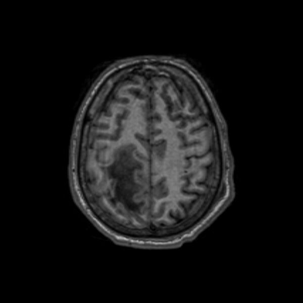 File:Brain abscess complicated by intraventricular rupture and ventriculitis (Radiopaedia 82434-96577 Axial T1 56).jpg