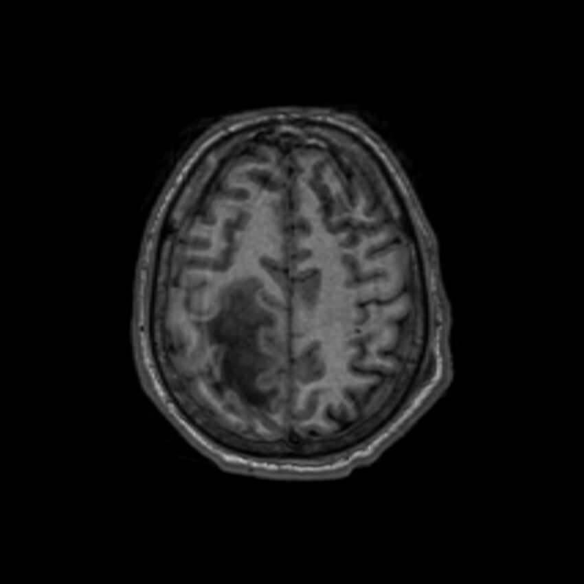 Brain abscess complicated by intraventricular rupture and ventriculitis (Radiopaedia 82434-96577 Axial T1 56).jpg