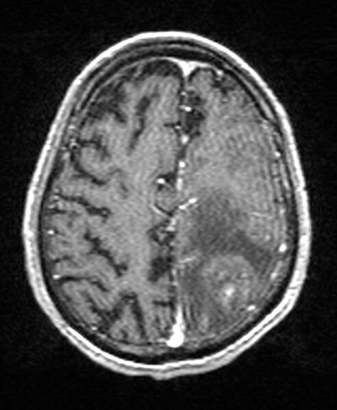 File:Brain abscess with dual rim sign (Radiopaedia 87566-103938 Axial T1 C+ 123).jpg