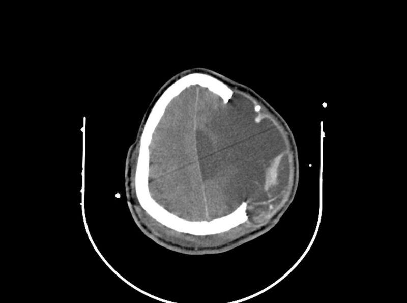 File:Brain injury by firearm projectile (Radiopaedia 82068-96087 B 147).jpg