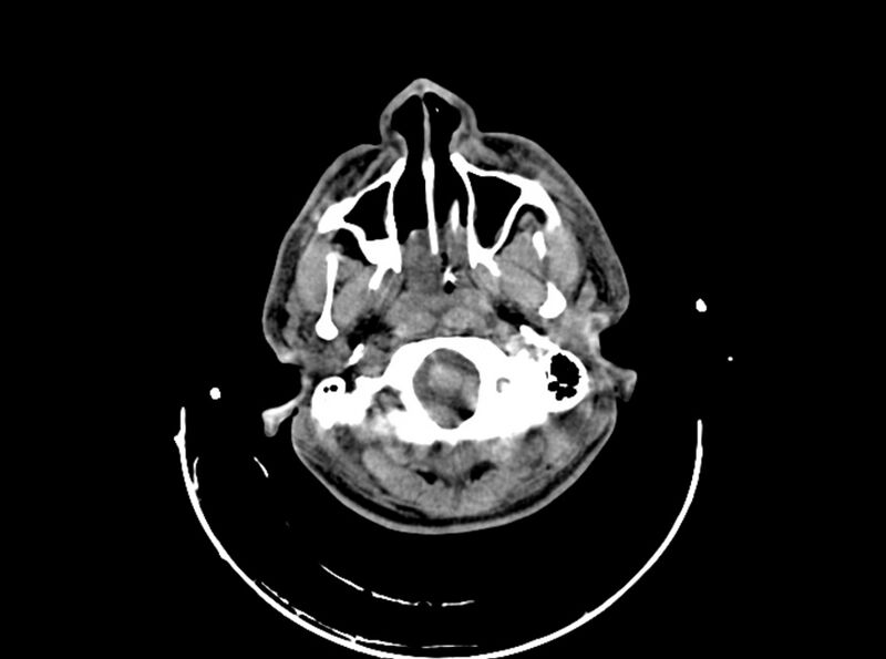 File:Brain injury by firearm projectile (Radiopaedia 82068-96087 B 43).jpg