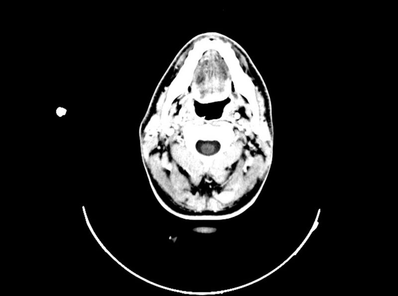 File:Brain injury by firearm projectile (Radiopaedia 82068-96088 B 42).jpg