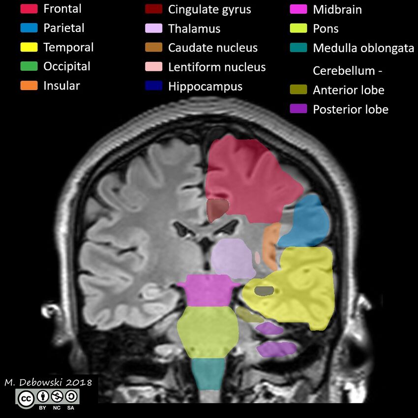Brain lobes - annotated MRI (Radiopaedia 61691-69700 Coronal 41).JPG