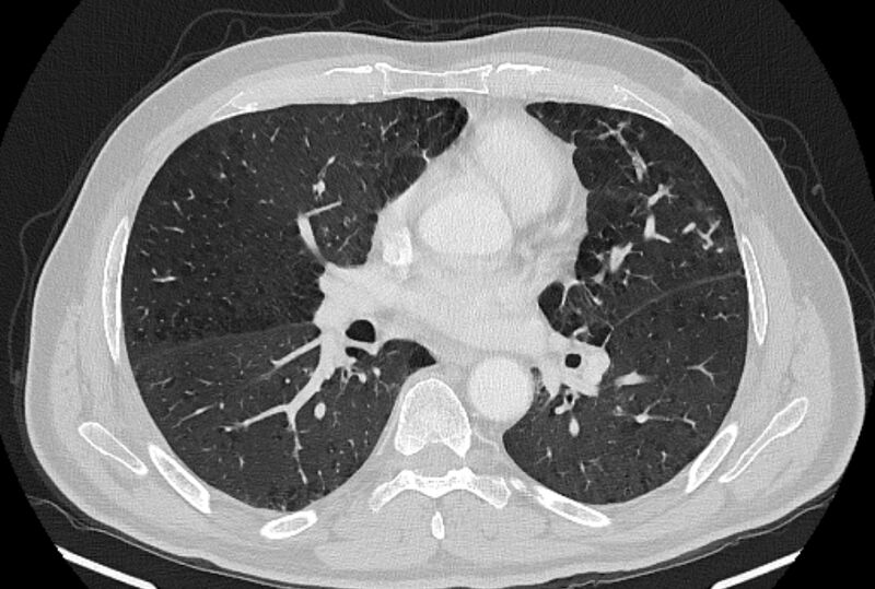 File:Brain metastases - lung cancer primary (Radiopaedia 75060-86116 Axial lung window 30).jpg