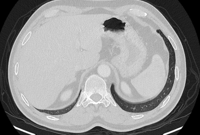 Brain metastases - lung cancer primary (Radiopaedia 75060-86116 Axial lung window 56).jpg