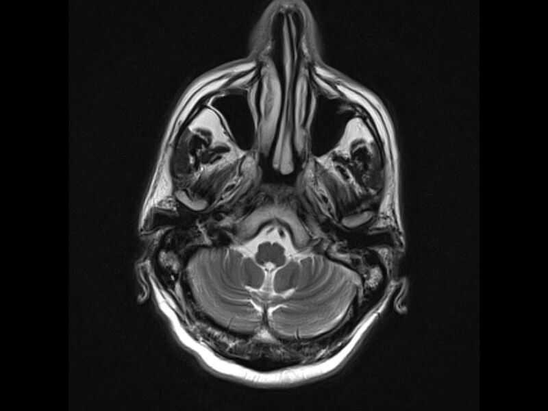 File:Brain metastases from renal cell carcinoma (Radiopaedia 42222-45297 Axial T2 5).jpg