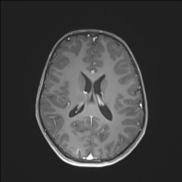 File:Brainstem glioma (Radiopaedia 70548-80674 Axial T1 C+ 97).jpg