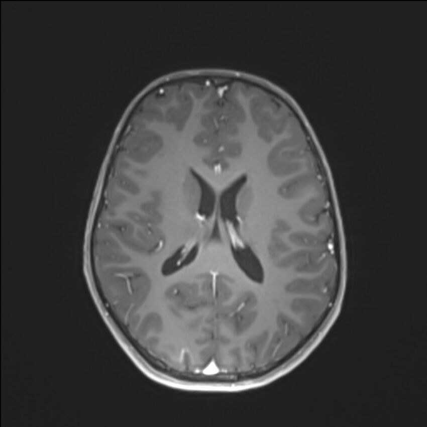 Brainstem glioma (Radiopaedia 70548-80674 Axial T1 C+ 97).jpg