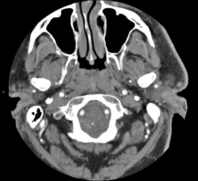 File:Brainstem hemorrhage (Radiopaedia 58794-66028 D 20).jpg