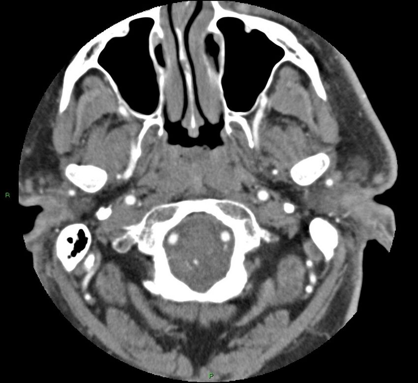 Brainstem hemorrhage (Radiopaedia 58794-66028 D 20).jpg