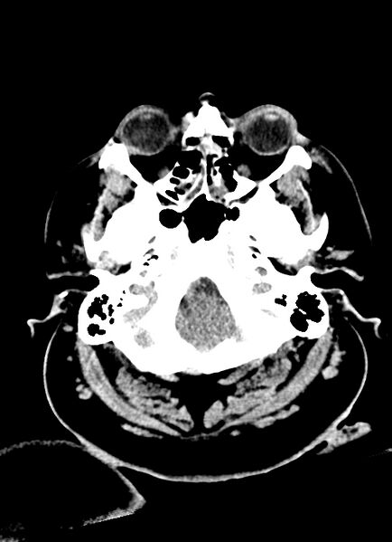 File:Brainstem hemorrhage (Radiopaedia 81294-94976 Axial non-contrast 53).jpg