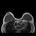Breast implants - MRI (Radiopaedia 26864-27035 Axial T1 23).jpg