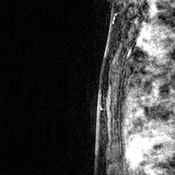 File:Breast implants - MRI (Radiopaedia 26864-27035 Sagittal T2 61).jpg