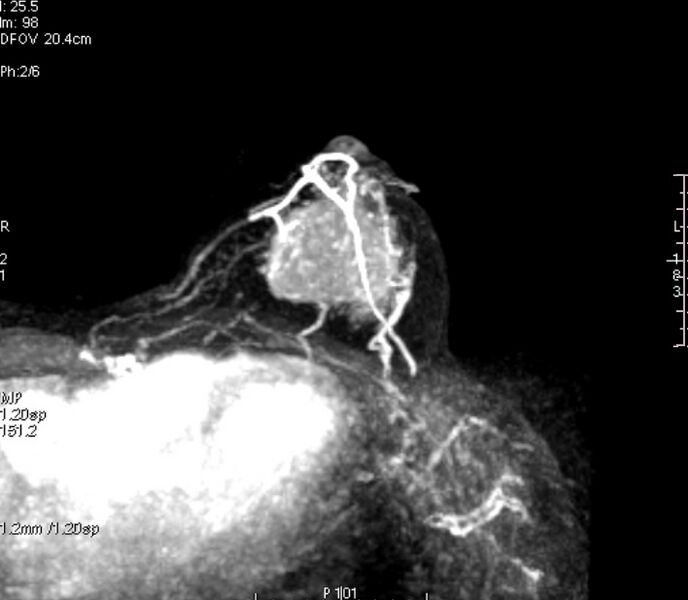File:Breast lymphoma (MRI) (Radiopaedia 34999-36498 Axial MIP 1).jpg