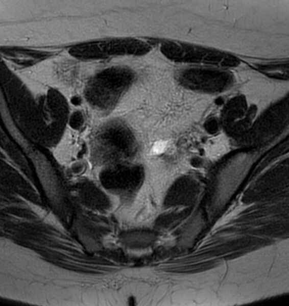 File:Broad ligament leiomyoma (Radiopaedia 81634-95516 Axial T2 8).jpg