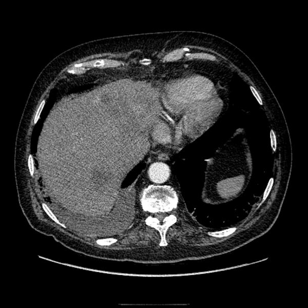 File:Bronchogenic adenocarcinoma and pulmonary embolism (Radiopaedia 9097-9806 D 49).jpg