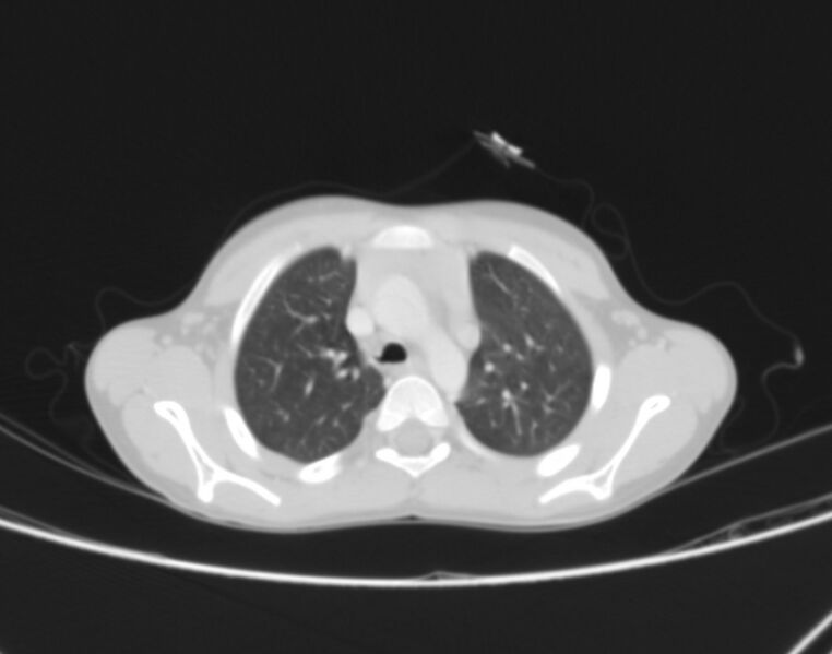 File:Bronchus suis (Radiopaedia 68131-77620 Axial lung window 12).jpg