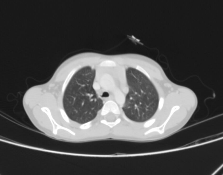 Bronchus suis (Radiopaedia 68131-77620 Axial lung window 12).jpg