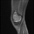 Bucket handle tear - lateral meniscus (Radiopaedia 72124-82634 Sagittal PD fat sat 15).jpg