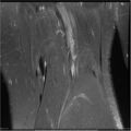 Bucket handle tear - lateral meniscus (Radiopaedia 7246-8187 Coronal T2 fat sat 2).jpg