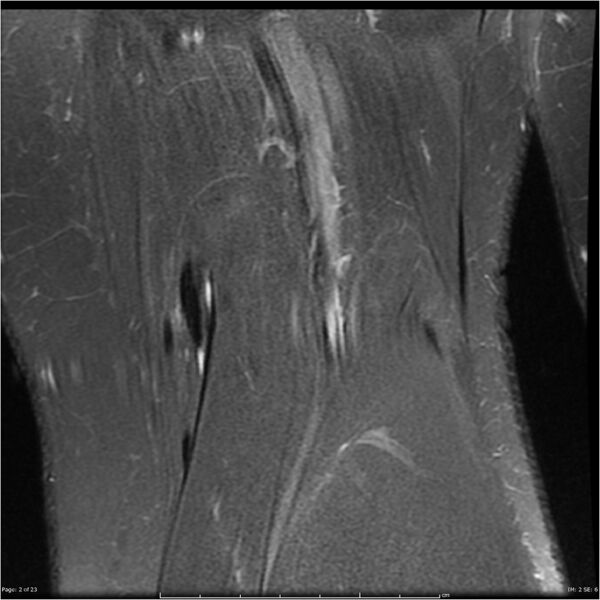 File:Bucket handle tear - lateral meniscus (Radiopaedia 7246-8187 Coronal T2 fat sat 2).jpg