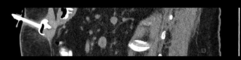 File:Buried bumper syndrome - gastrostomy tube (Radiopaedia 63843-72575 Sagittal Inject 52).jpg