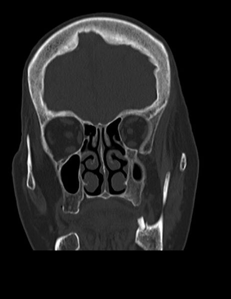 File:Burnt-out meningioma (Radiopaedia 51557-57337 Coronal bone window 12).jpg