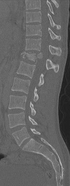 File:Burst fracture - T12 with conus compression (Radiopaedia 56825-63647 Sagittal bone window 39).png