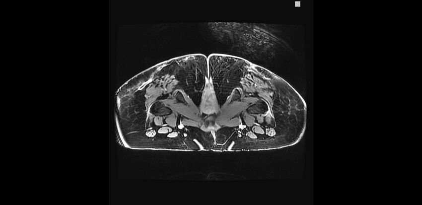 Buttock filler complications (Radiopaedia 63497-72115 Axial T1 C+ 46).jpg