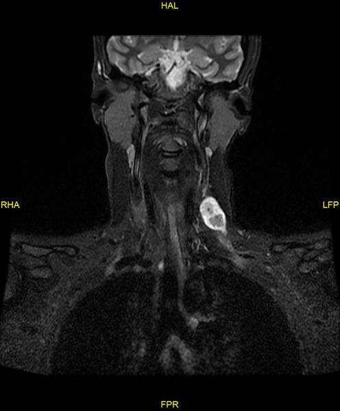 File:C5 nerve sheath tumor (Radiopaedia 85777-101596 Coronal T2 fat sat 8).jpg