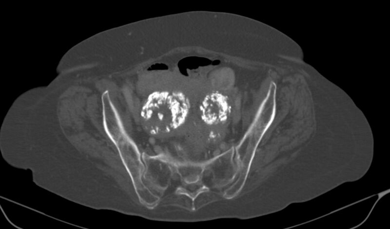 File:Calcified fibroids (Radiopaedia 20306-20228 Axial bone window 15).jpg