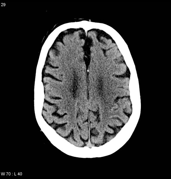 File:Calcified left middle cerebral artery embolism (Radiopaedia 5570-22120 Axial non-contrast 9).jpg