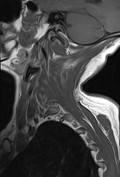 File:Calcified meningioma - cervical canal (Radiopaedia 70136-82468 Sagittal T1 1).jpg