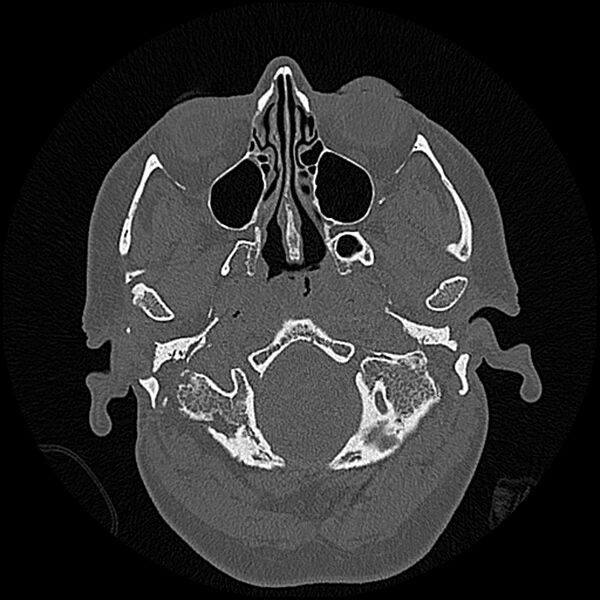 File:Canal up mastoidectomy (Radiopaedia 78108-90638 Axial bone window 23).jpg