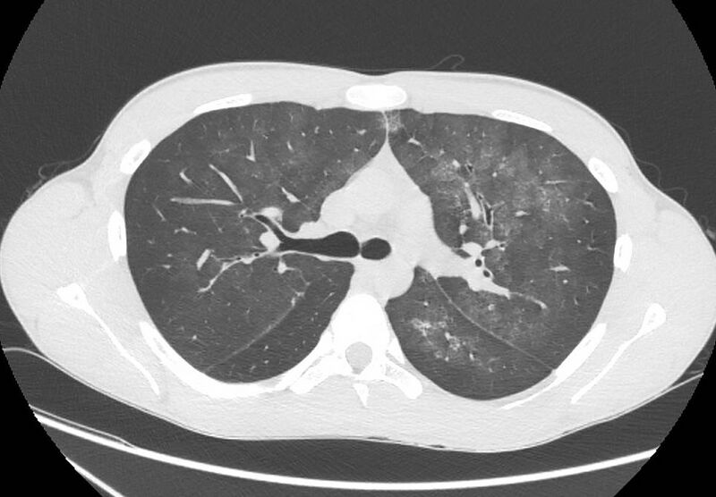 File:Cannabis-induced diffuse alveolar hemorrhage (Radiopaedia 89834-106946 Axial lung window 42).jpg