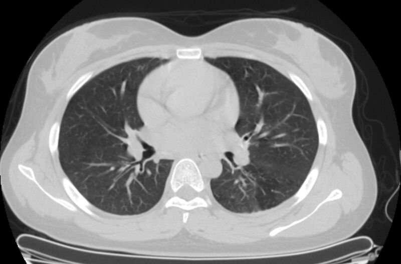 File:Cannonball metastases - uterine choriocarcinoma (Radiopaedia 70137-80173 Axial lung window 46).jpg