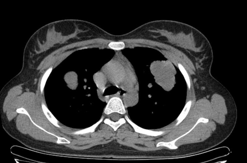File:Cannonball metastases - uterine choriocarcinoma (Radiopaedia 70137-80173 Axial non-contrast 32).jpg