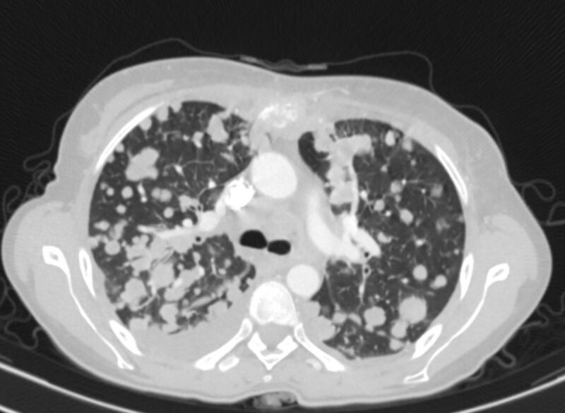 File:Cannonball metastases from breast cancer (Radiopaedia 91024-108569 Axial lung window 33).jpg