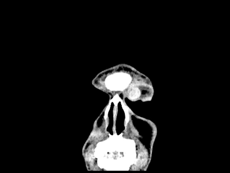 File:Capillary hemangioma of the orbit (Radiopaedia 44610-48358 B 11).jpg