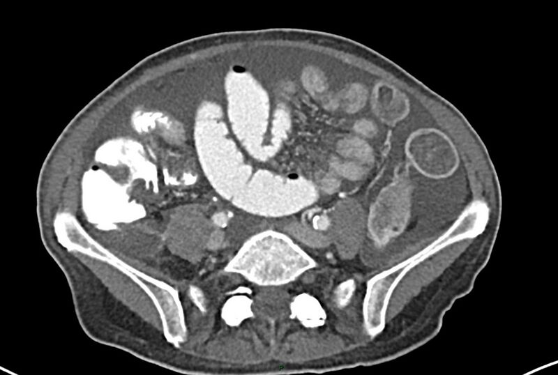 File:Carcinoid mesenteric tumor complicated by chylous ascites (Radiopaedia 76312-87953 A 51).jpg