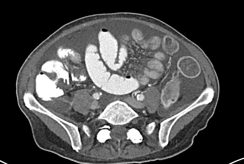Carcinoid mesenteric tumor complicated by chylous ascites (Radiopaedia 76312-87953 A 51).jpg