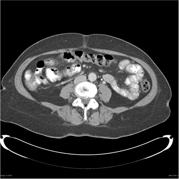 File:Carcinoid tumor of the ileum with metastasis to orbit (Radiopaedia 28165-28425 A 9).jpg
