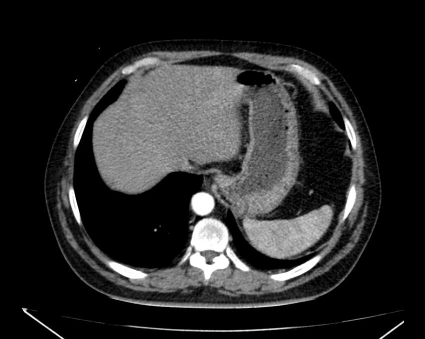 Carcinoid tumor with hepatic metastases (Radiopaedia 22651-22670 B 13).jpg
