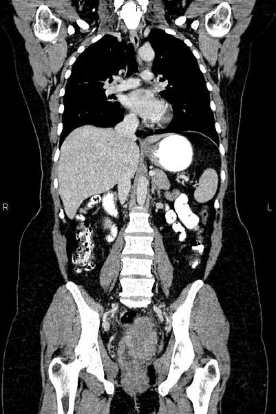 File:Carcinoma of uterine cervix (Radiopaedia 85861-101700 C 31).jpg