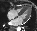Cardiac amyloidosis (Radiopaedia 39736-42124 D 11).jpg