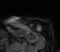 Cardiac amyloidosis (Radiopaedia 39736-42124 F 5).jpg