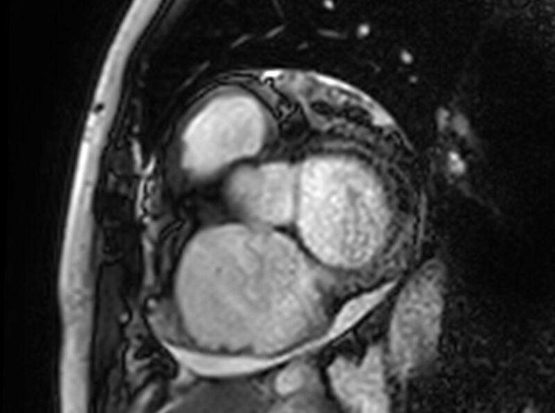 File:Cardiac amyloidosis (Radiopaedia 61600-69579 Short axis bSSFP 322).jpg