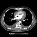 Cardiac tamponade (Radiopaedia 78607-91368 Axial C+ CTPA 53).jpg