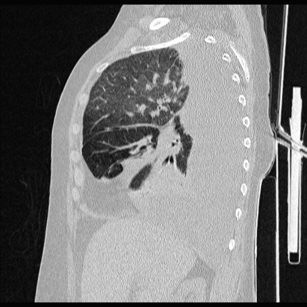 File:Cardiogenic pulmonary edema (Radiopaedia 29213-29609 Sagittal lung window 32).jpg